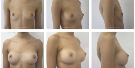 Prothèses mammaires anatomiques polyuréthane de 240cc profil standard