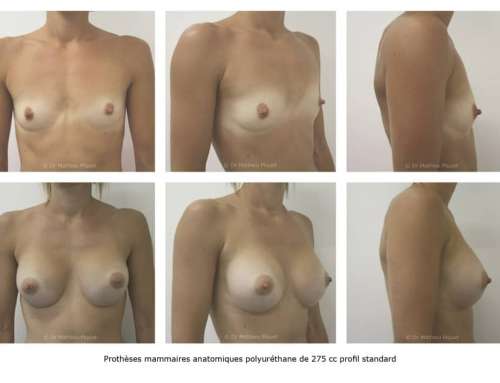 Prothèses mammaires Avant/Après