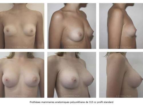 Prothèses mammaires Avant/Après