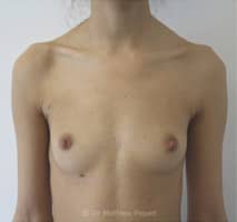 Prothèses mammaires anatomiques polyuréthane de 240cc profil standard