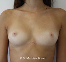 Protheses mammaires anatomiques polyurethane