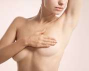 Ptôse mammaire : lifting des seins ou prothèses ?