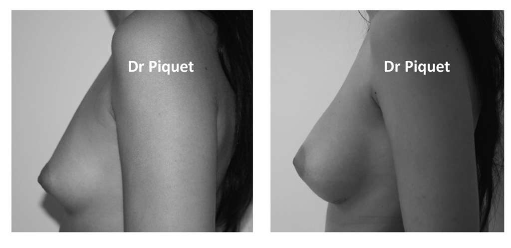 Prothèses mammaire anatomiques de 270 cc en avant du muscle grand pectoral